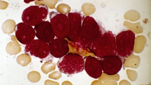 _88291939_c0151810-acute_lymphoblastic_leukaemia,_micrograph-spl.jpg